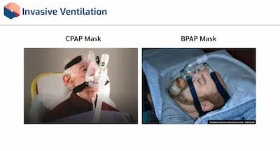 Artificial Ventilation IV 2