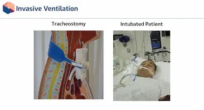 Artificial Ventilation IV