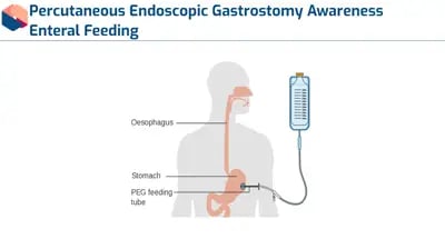 PEG Feeding Diagram